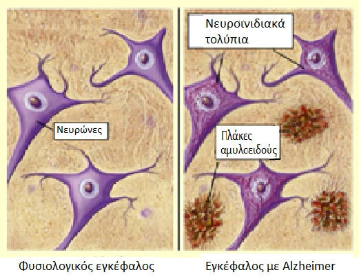 A. Εικόνα νευρώνων φυσιολογικού εγκεφάλου. B. Εικόνα νευρώνων εγκεφάλου με Alzheimer με χαρακτηριστικά την εμφάνιση των νευροινιδιακών τολυπίων στο εσωτερικό των νευρώνων (μέτρηση της πρωτεΐνης p-Tau217) και την εμφάνιση των πλακών αμυλοειδούς (μέτρηση του β-Αμυλοειδές 1-42 (Aβ42) A. Εικόνα νευρώνων φυσιολογικού εγκεφάλου. B. Εικόνα νευρώνων εγκεφάλου με Alzheimer με χαρακτηριστικά την εμφάνιση των νευροινιδιακών τολυπίων στο εσωτερικό των νευρώνων (μέτρηση της πρωτεΐνης p-Tau217) και την εμφάνιση των πλακών αμυλοειδούς (μέτρηση του β-Αμυλοειδές 1-42 (Aβ42)