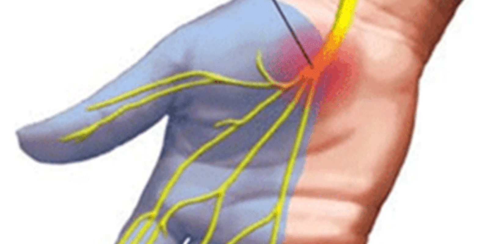 Το σύνδρομο καρπιαίου σωλήνα «προτιμά» γυναίκες και αφορά έως και το 5% του πληθυσμού