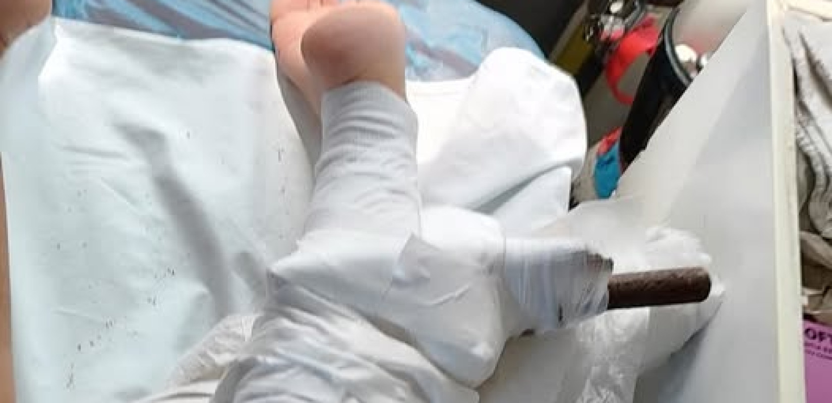 Χαλκιδική: Σκουριασμένη ομπρέλα καρφώθηκε στο πόδι λουόμενης στο Ποσείδι - Άμεση επέμβαση διασώστη του ΕΚΑΒ