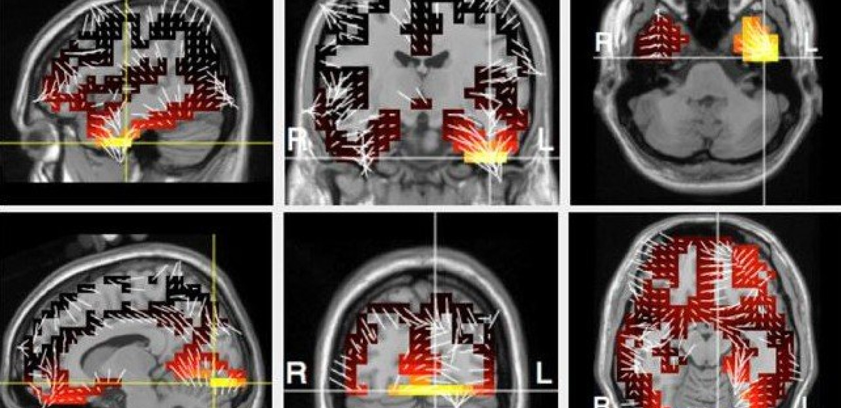 Θεσσαλονίκη - 2D-BioPAD: Έρευνα για δημιoυργία ψηφιακού εργαλείου έγκαιρη διάγνωσης Alzheimer